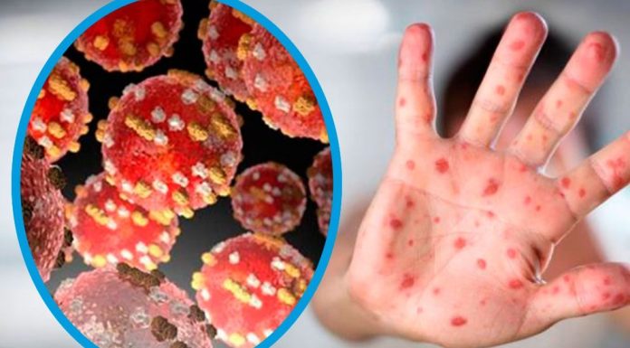 Jalisco detecta primer caso de viruela símica Viruela Símica.