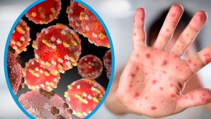 2022052410052684539 Viruela Símica.