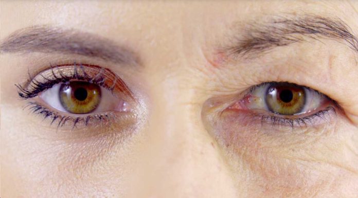 ¿Por qué se caen los párpados al aumentar la edad?